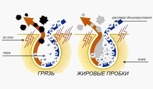 Принцип действия дезинкрустации или гальванической чистки