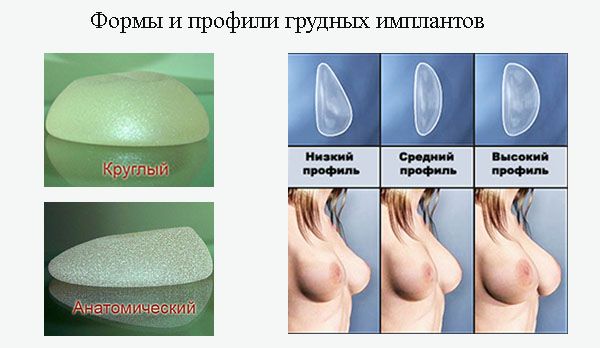 Формы и профили грудных имплантов