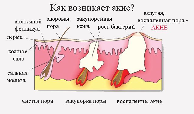 Процесс развития акне