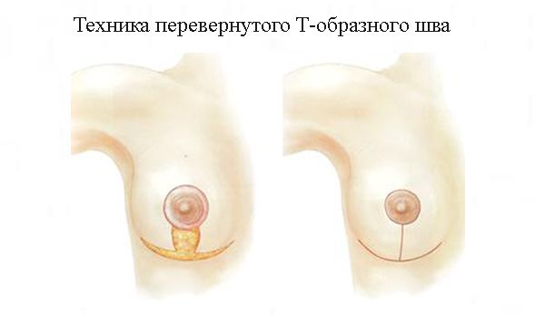 Редукционная маммопластика техникой Т-образного шва