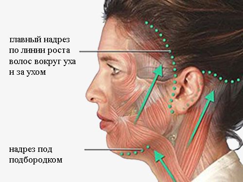 Техника проведения круговой подтяжки лица и шеи
