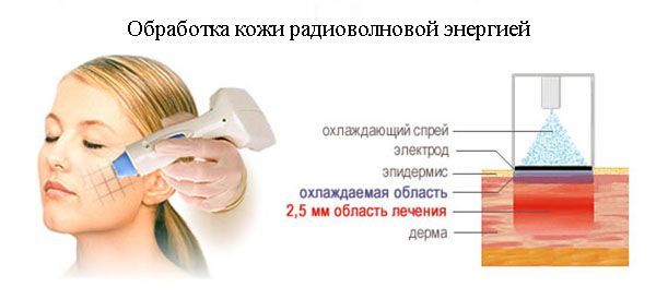 Обработка кожи радиоволновой энергией