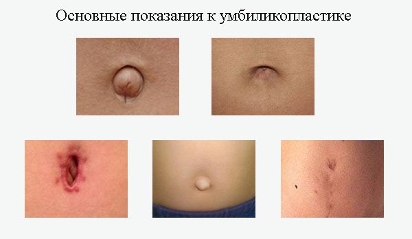 Основные показания к умбиликопластике