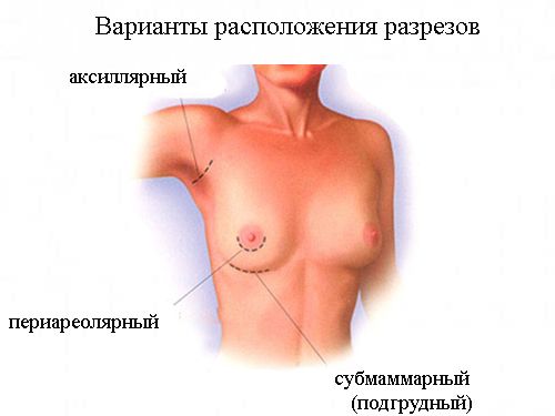 Варианты разрезов при аугментационной маммопластике
