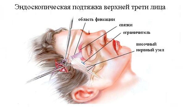 Эндоскопическая подтяжка верхней трети лица