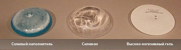 Виды грудных имплантов в зависимости от наполнителя