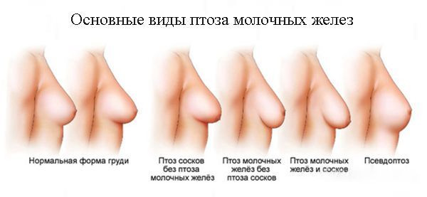 Виды птоза молочных желез