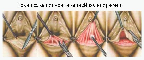 Техника выполнения задней кольпорафии