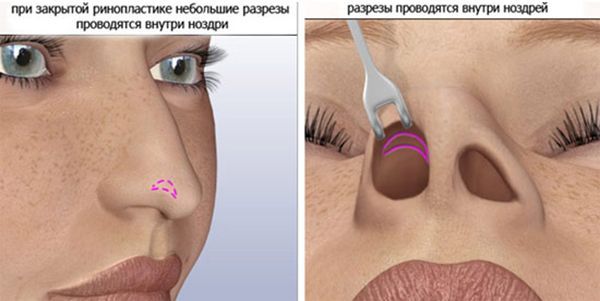 Техника выполнения закрытой ринопластики